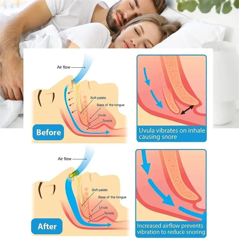 Anti snoring corrector